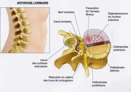 Traiter l'arthrose lombaire sans médicaments