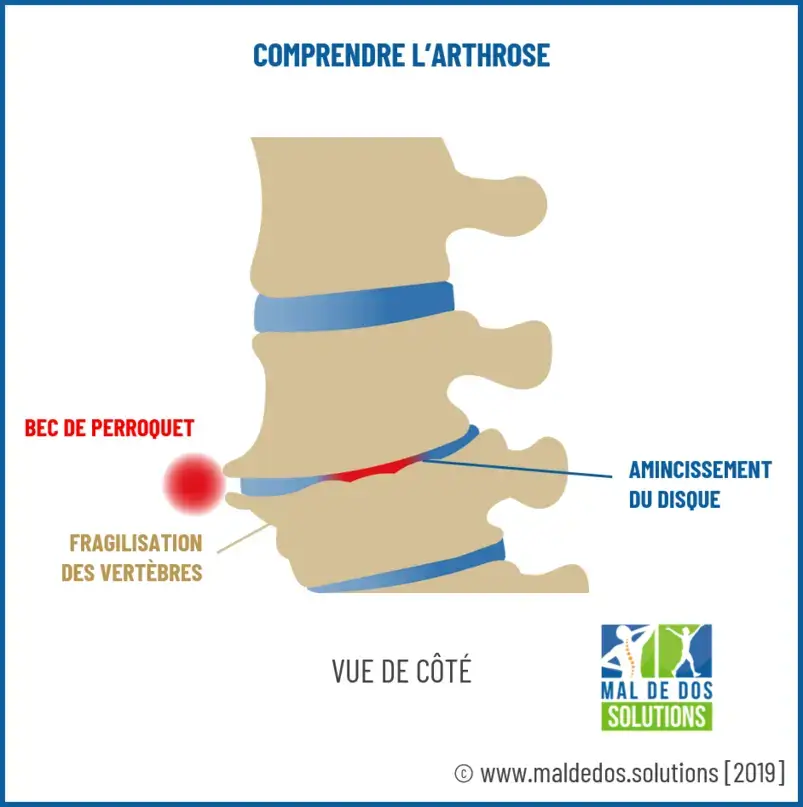 Mal de dos dû à une arthrose lombaire