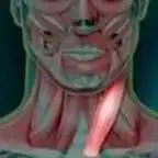 cervicalgie aiguë