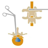 Mal de dos ceinture lombaire