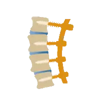 Chirurgie du dos et arthrodèse