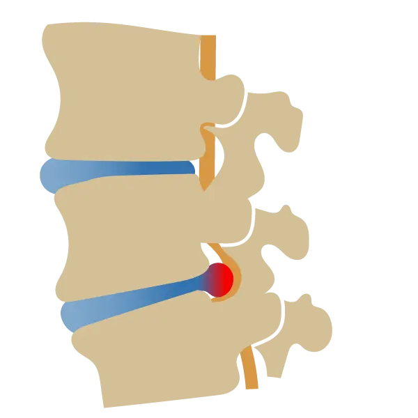 Mal de dos hernie discale cervicale