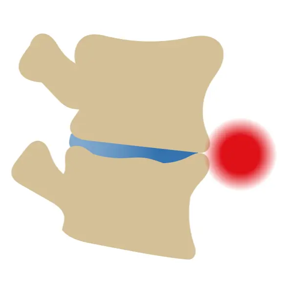 Pincement discal