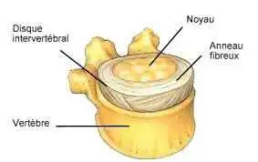 Pincement discal